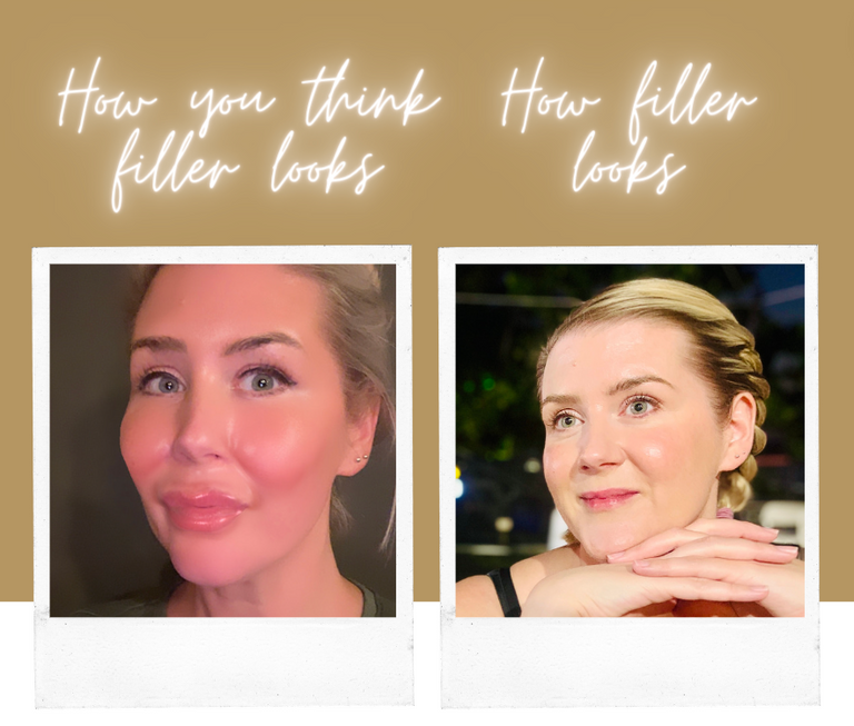How do avoid fillers looking fake | Glowday