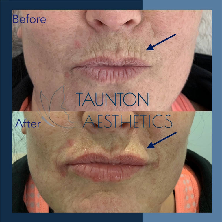 How To Treat Menopause Lips Glowday