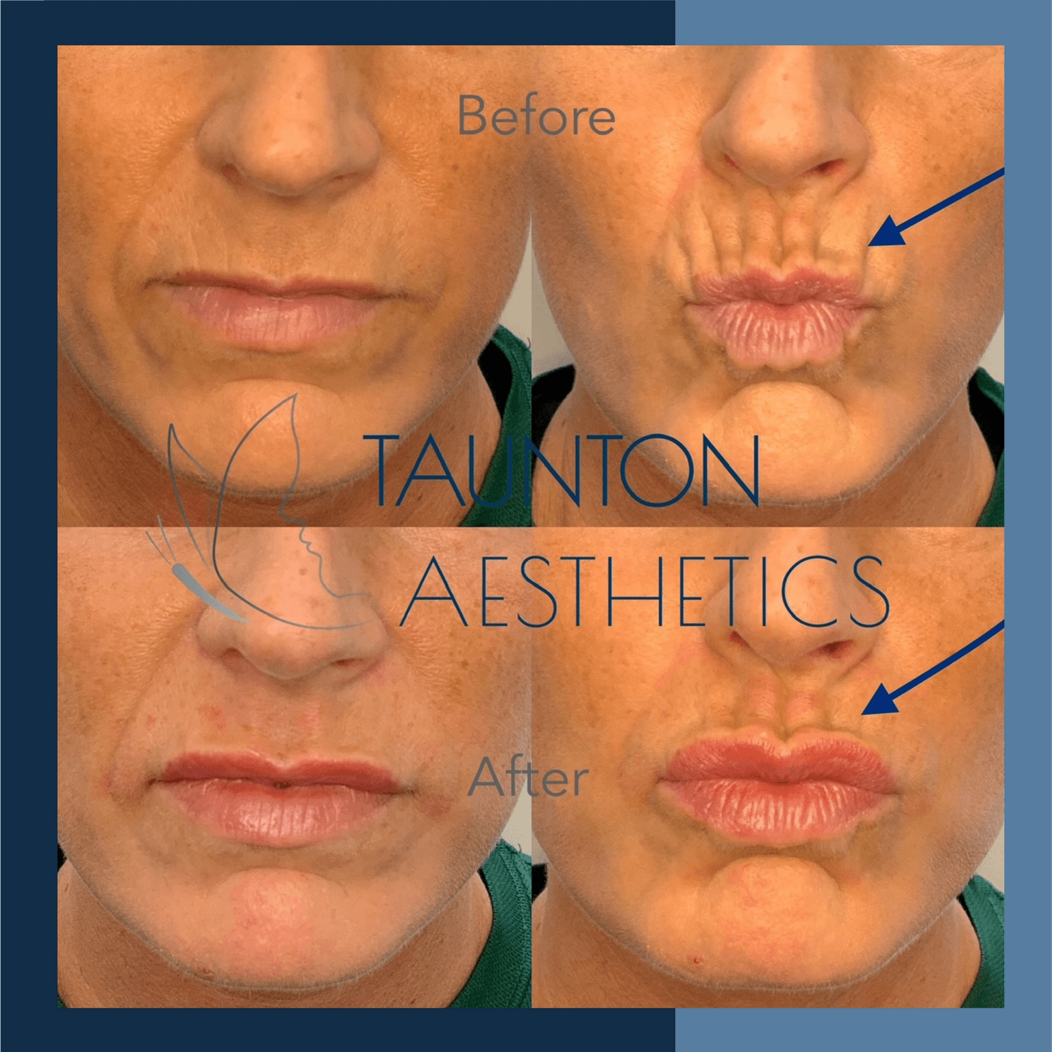 How To Treat Menopause Lips Glowday