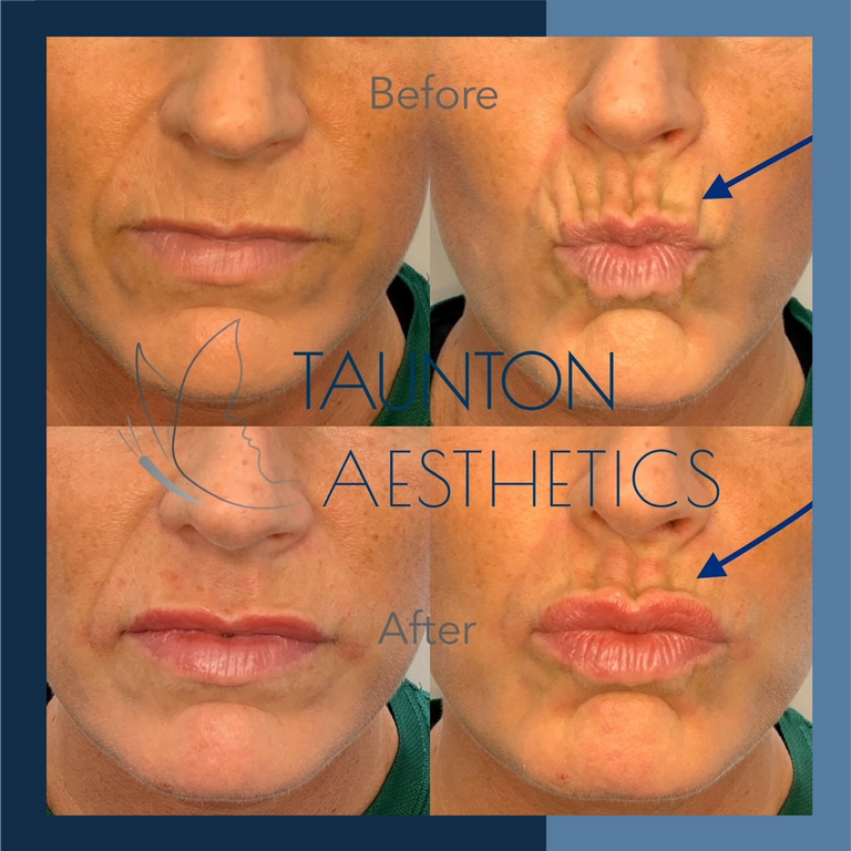 How To Treat Menopause Lips Glowday