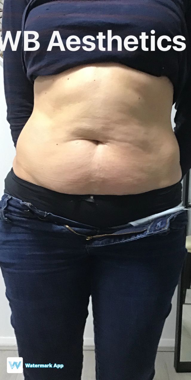 Patient before fat reduction treatment with WB Aesthetics