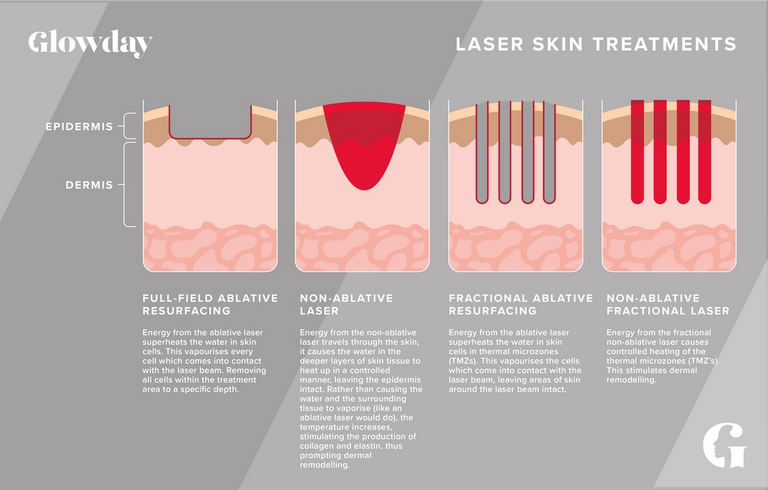 Non ablative Laser Resurfacing Glowday