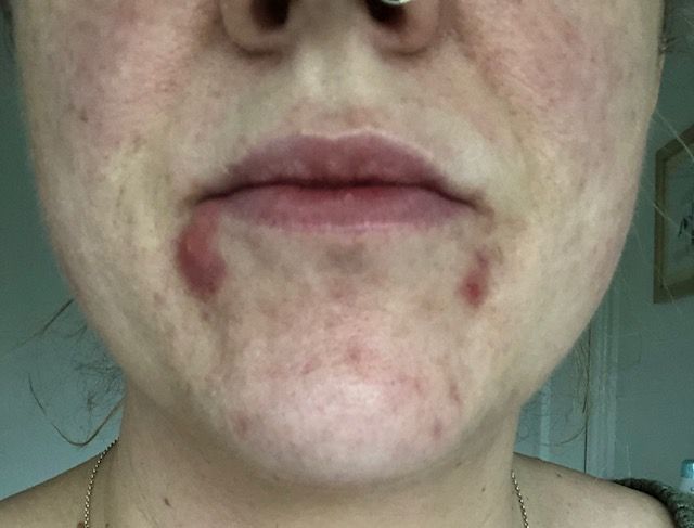 Shelley's painful cystic acne