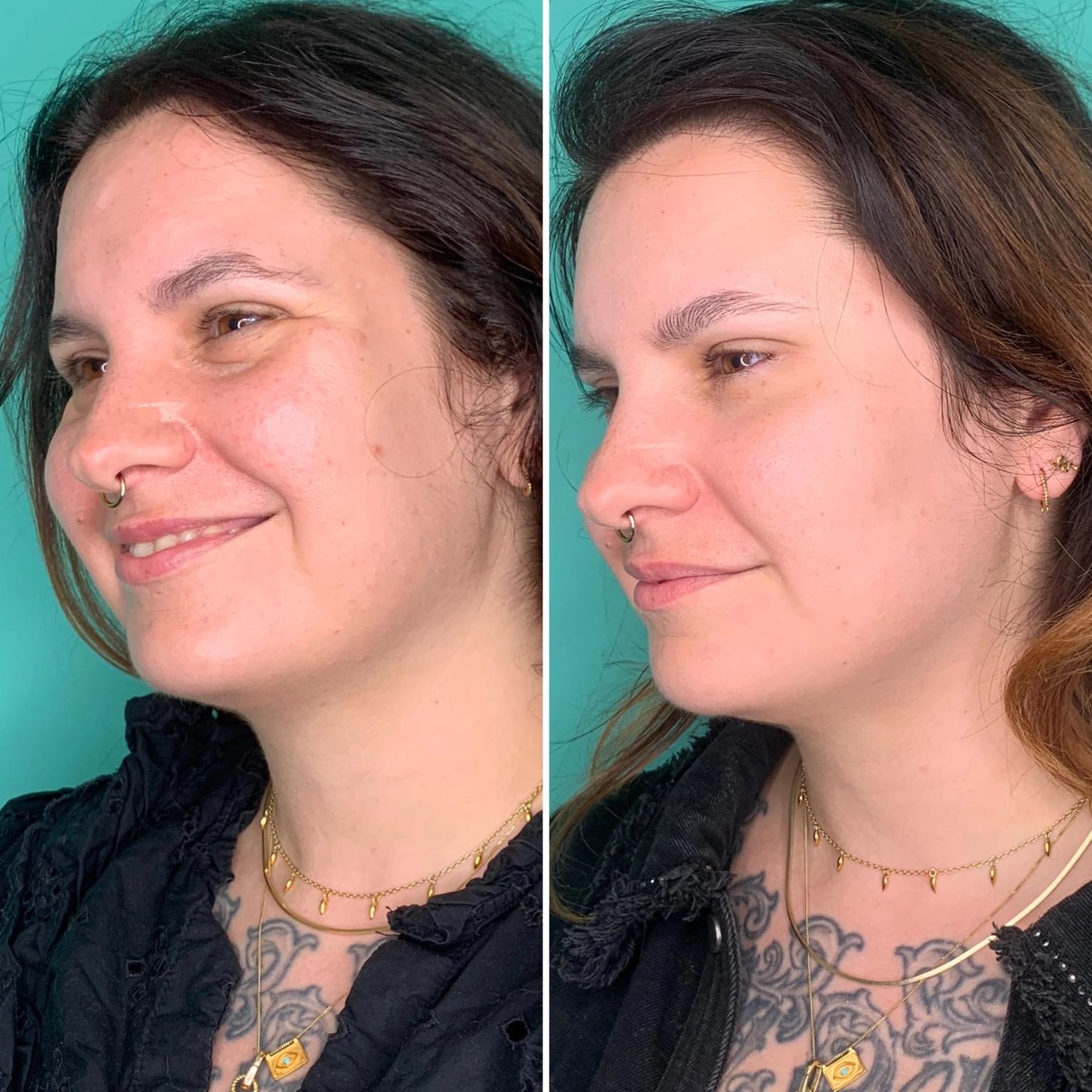 Botox before and after results by Emma Goldsmith