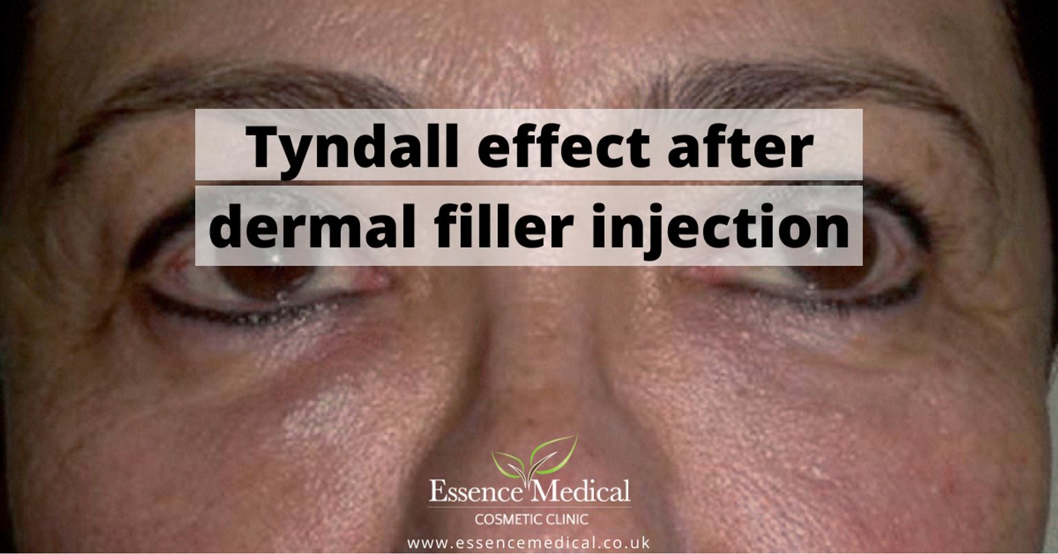 tyndall effect skin