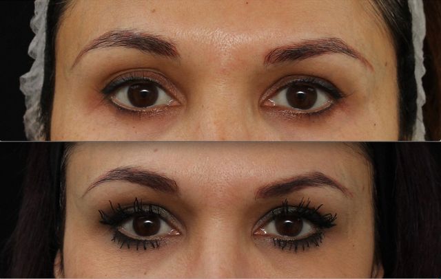 Dr Manav Bawa temple filler before and after image