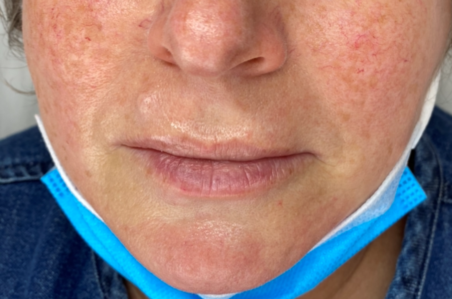 Ella's lips before lip filler for asymmetry