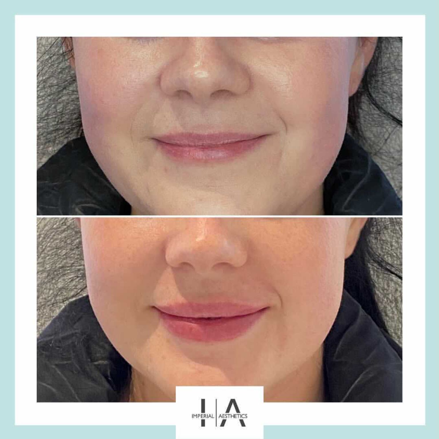 Daniel Hunt - Lip filler before and after - Glowday