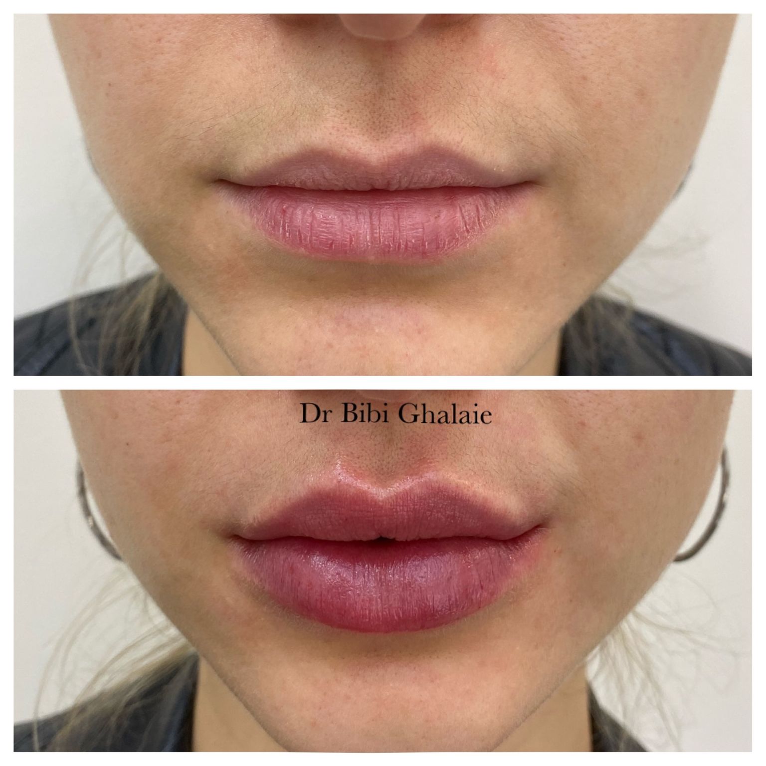 Top 10 Lip Fillers In London Glowday