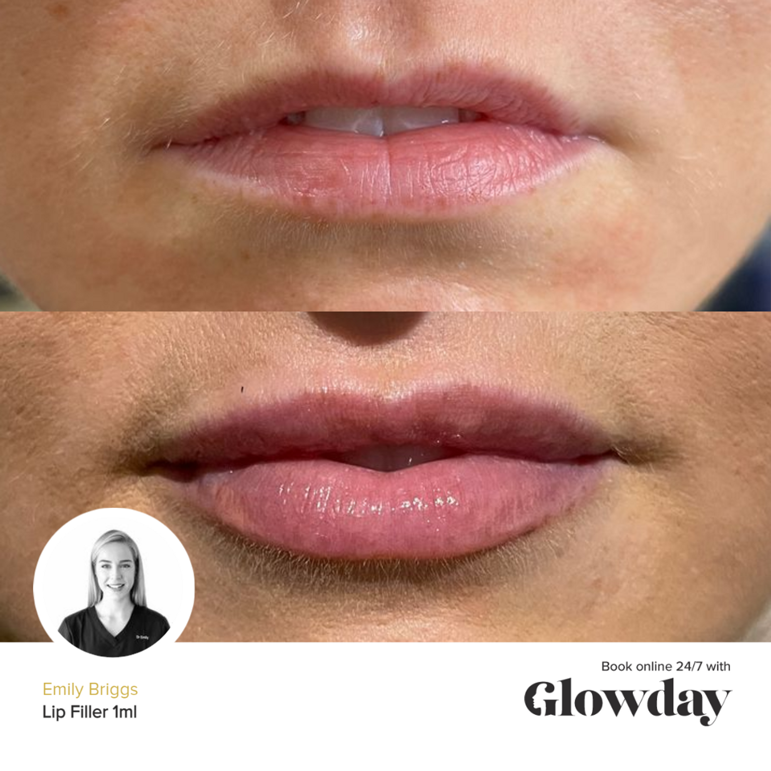 Emily Briggs - Before and After Lip Fillers - Glowday