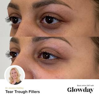 Tear trough fillers: your questions answered! | Glowday