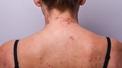 banner for Bacne: Best Treatment For Back Acne