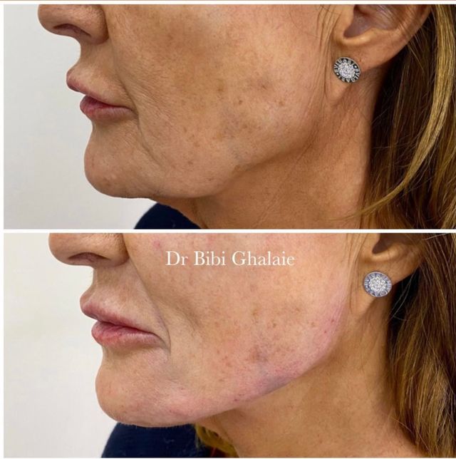 Jawline filler before and after - Dr Bibi Ghalaie - Glowday