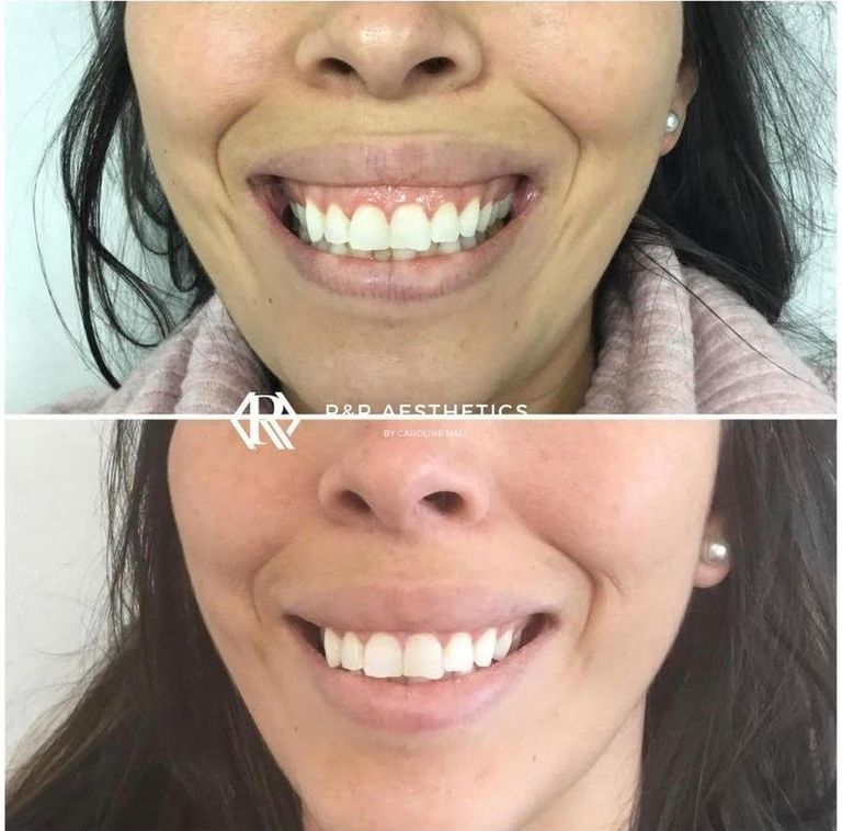 The Lip Flip What Is It? Glowday