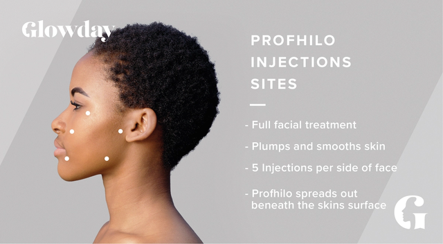 Profhilo Injection Sites