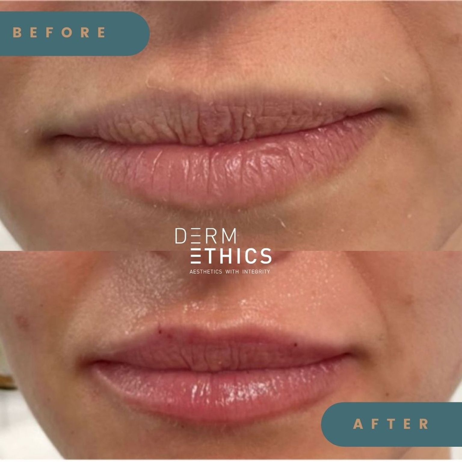 Naresh Singh - Before and After Lip Fillers - Glowday 