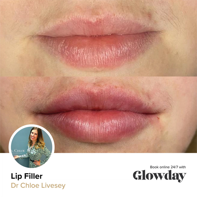 Lip filler before and after by Dr Chlow Livesey