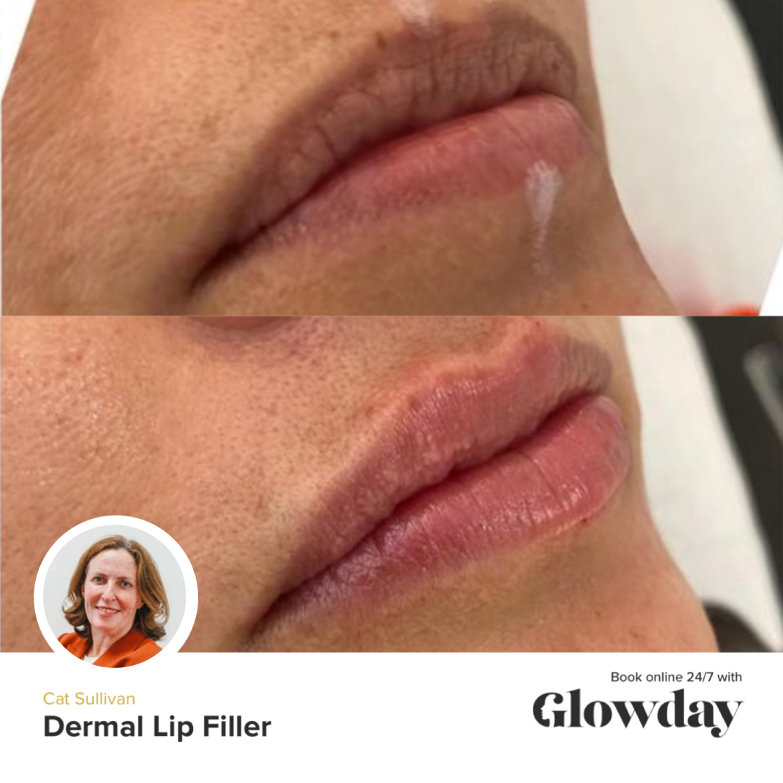 Lip Fillers Before And After - Cat Sullivan - Glowday