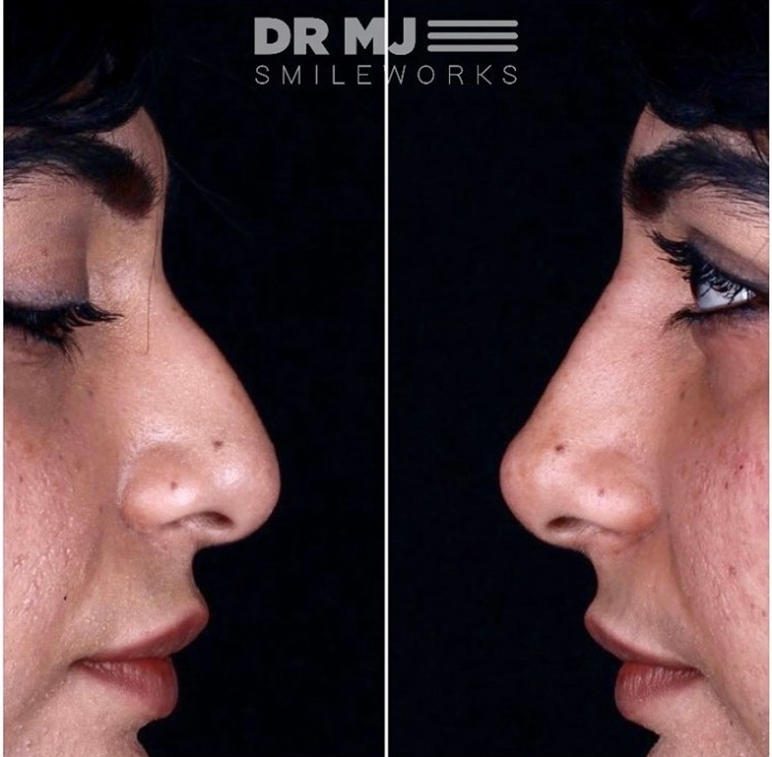 Liquid nose job before and after