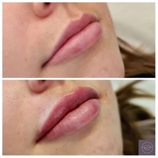 Top 10 Lip Fillers In London Glowday