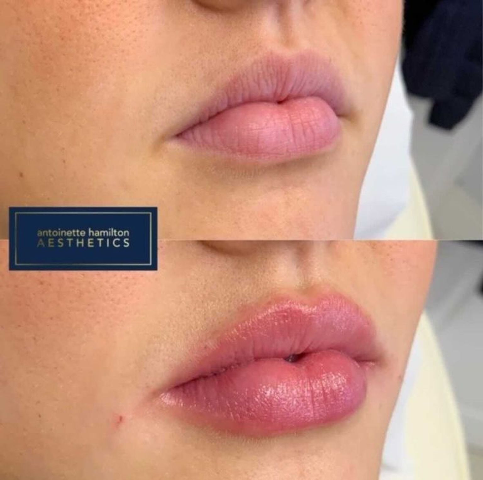 Lip fillers before and after