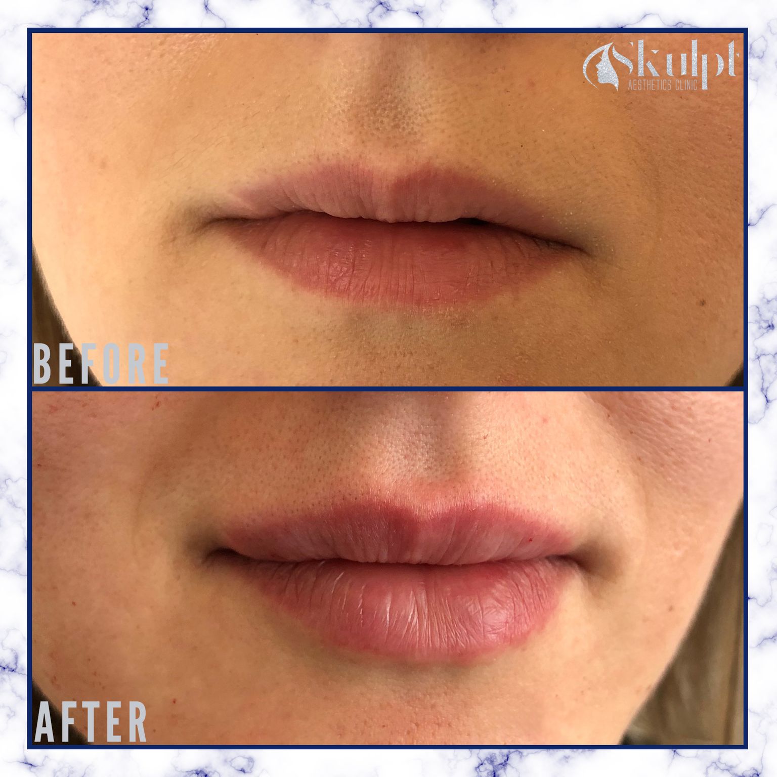 Jesal lip filler before and after image