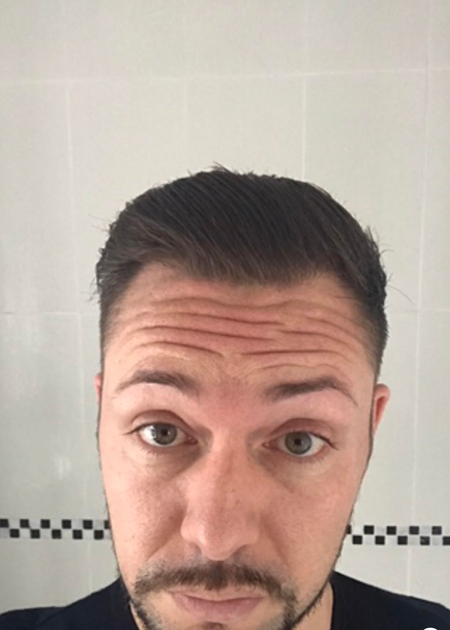 Curt before Botox