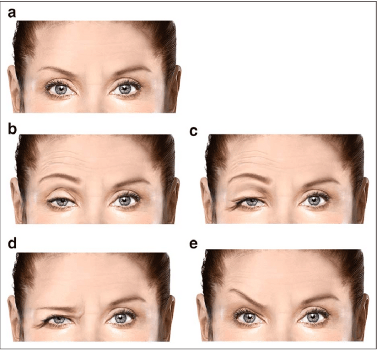 ptosis-explained-what-it-is-and-how-to-avoid-it-glowday