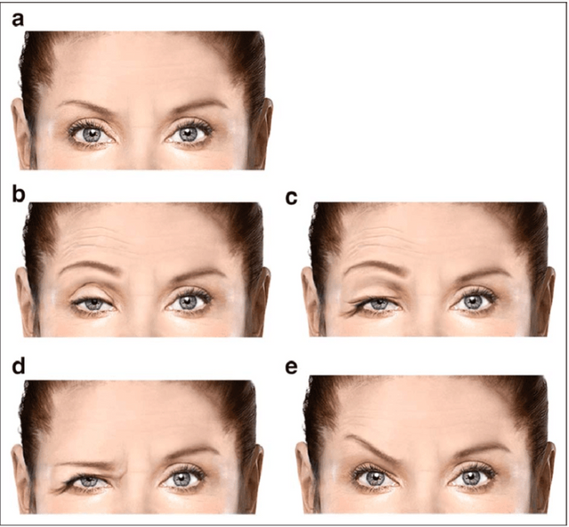 Image B) is an example of lid ptosis; image D) is an example of brow ptosis. Image credit: https://www.researchgate.net/figure/Various-depictions-of-ptosis-a-No-ptosis-b-Lid-ptosis-with-compensatory-frontal_fig2_315827436