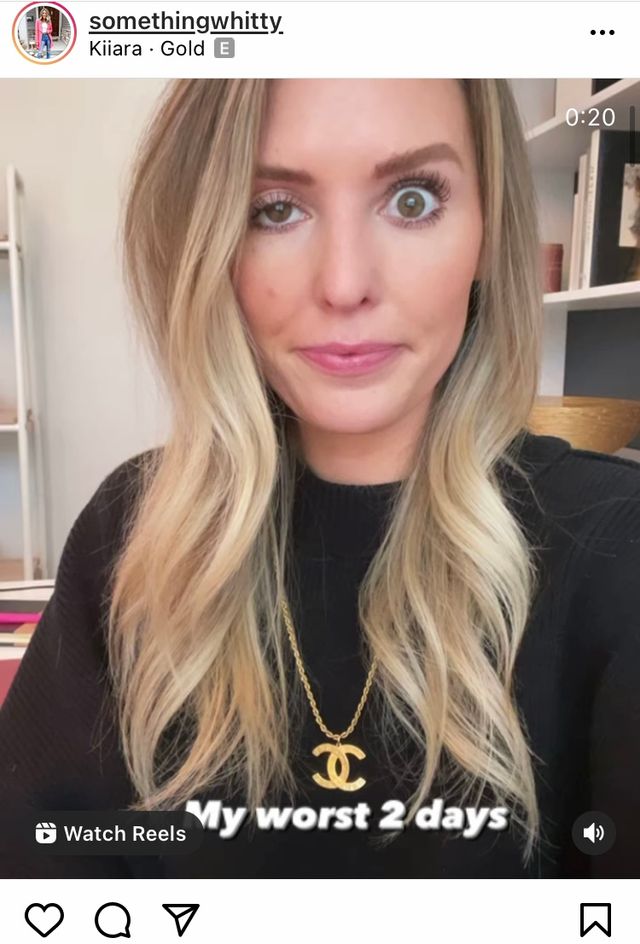 Blogger Whitney Buha shows how ptosis affected her eye lid. Photo credit: Whitney Buha, Instagram
