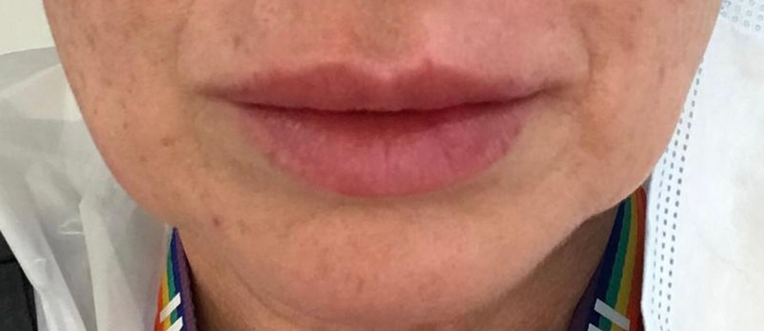 Ella's lips after lip filler to treat asymmetry