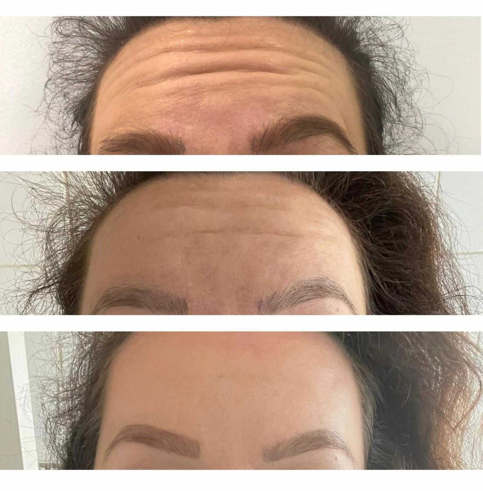 Chelsea's Botox before and after results