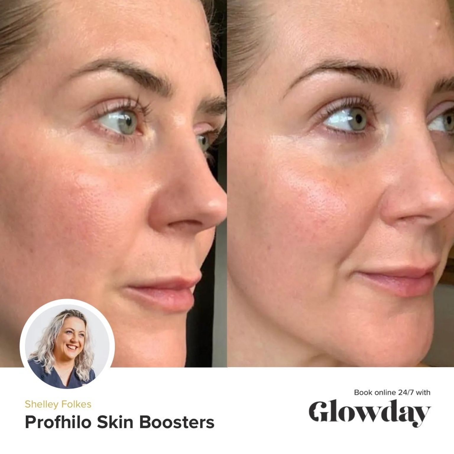 Profhilo before and after results - by Shelley Folkes