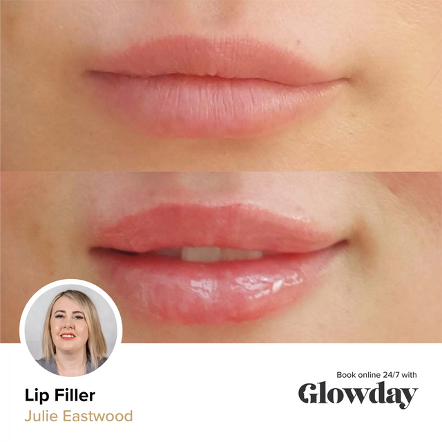 Lip filler before and after - Julie Eastwood