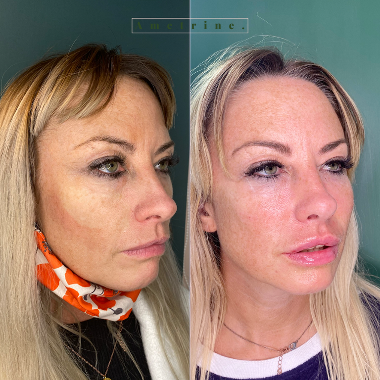 Do Fillers Ruin Your Face? Glowday