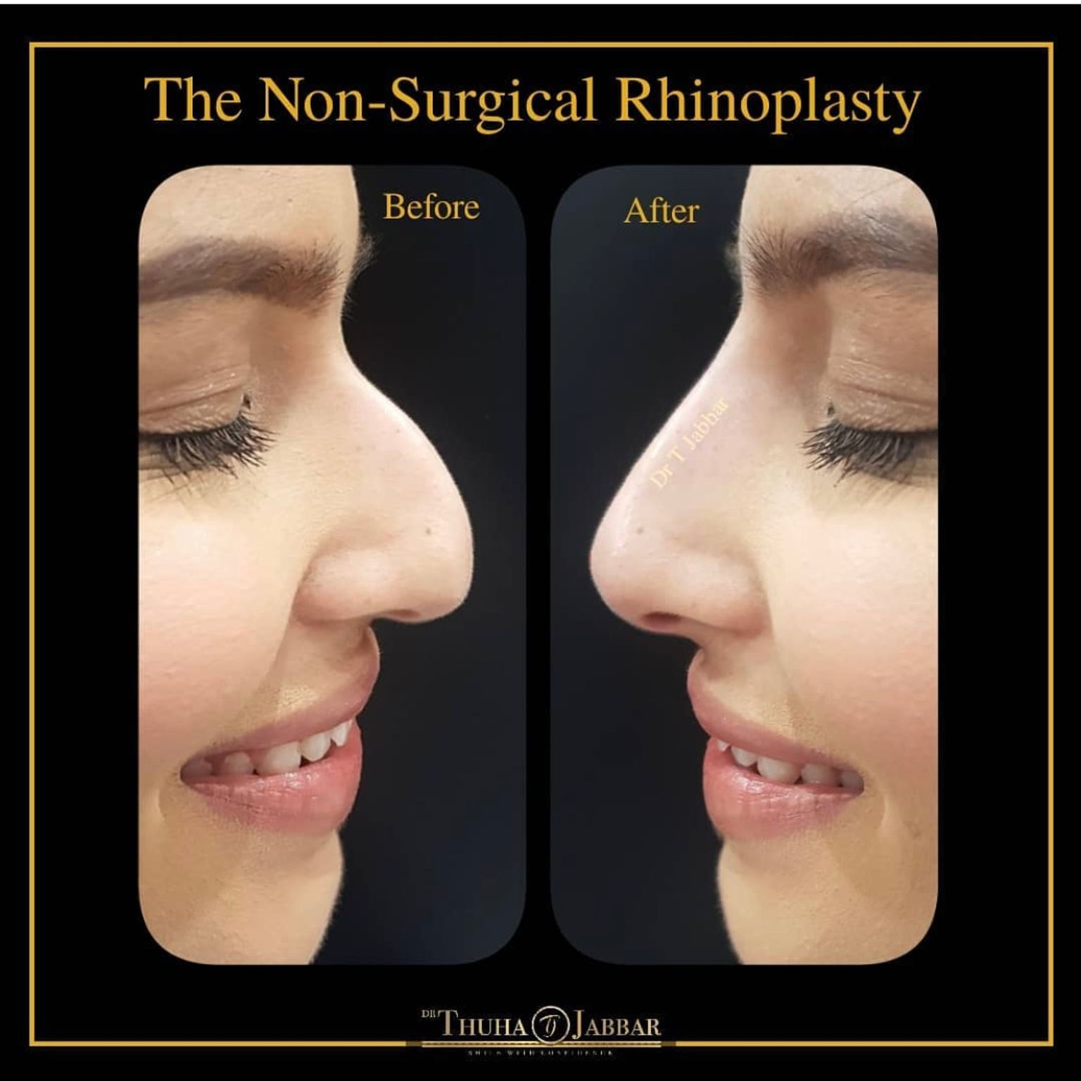Liquid nose job before and after - by Dr Jabbar