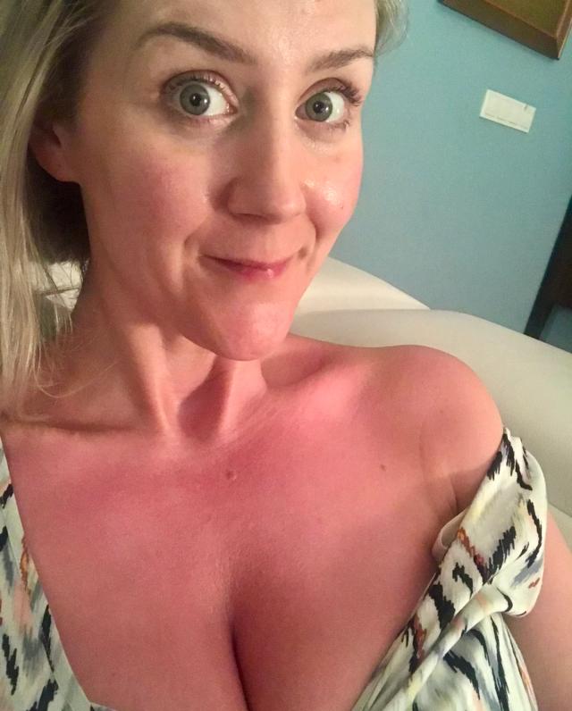 This is me following a few hours without suncream on an overcast, windy day...🤦🏼‍♀️