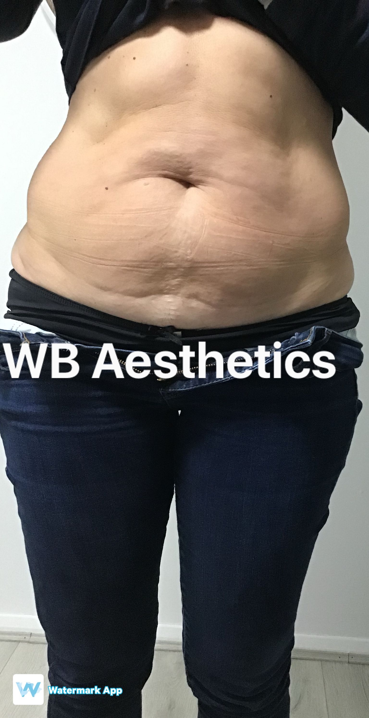 Patient after fat reduction treatment with WB Aesthetics