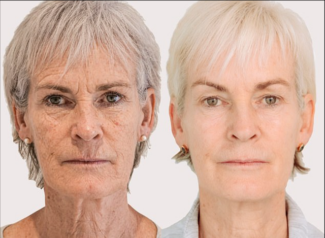 Judy had three sessions of the Morpheus8 treatment over the course of a year, alongside the Obagi NuDerm system and looks amazing as a result (Photo credit: Cavendish Media)