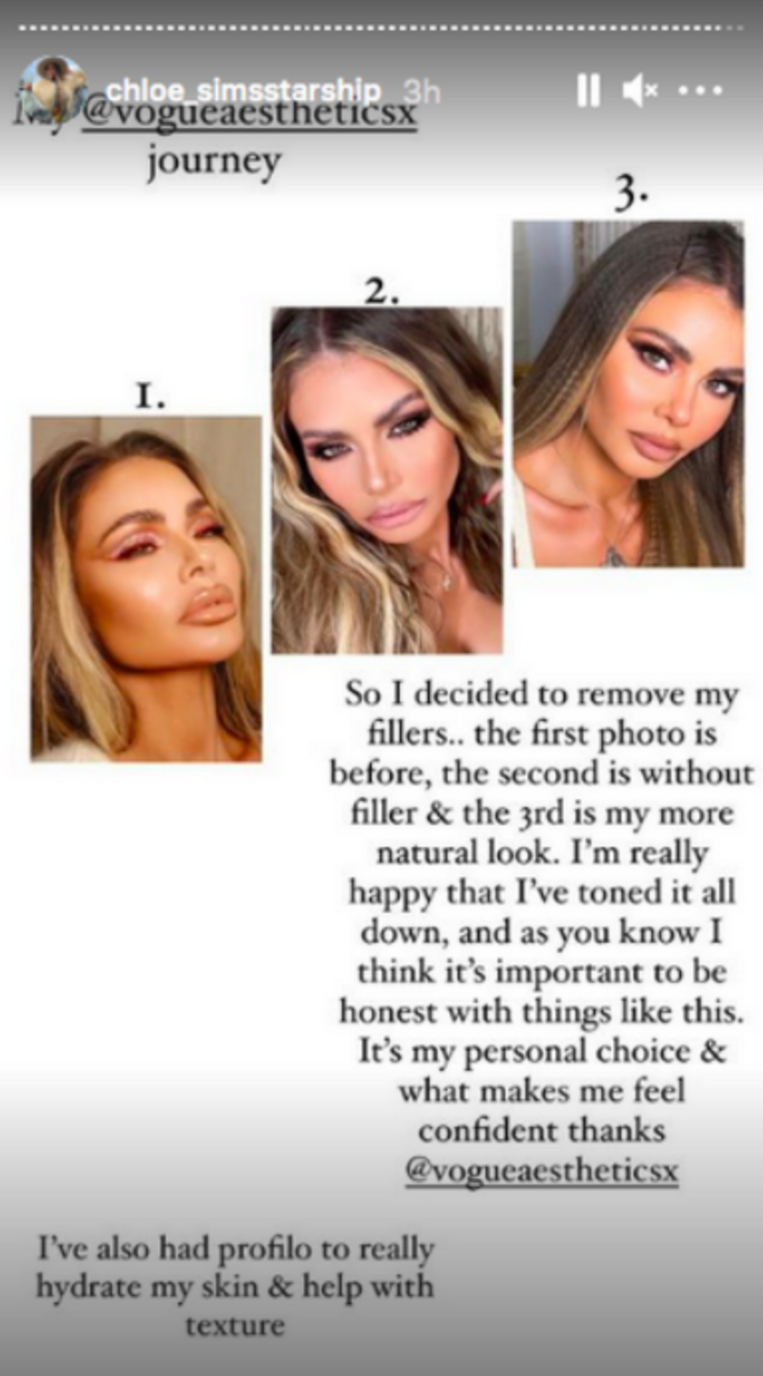 Chloe Sims says she's dissolved her filler. Photo credit: Chloe Sims, Instagram