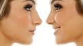 banner for Everything You Need To Know About The Non Surgical Nose Job
