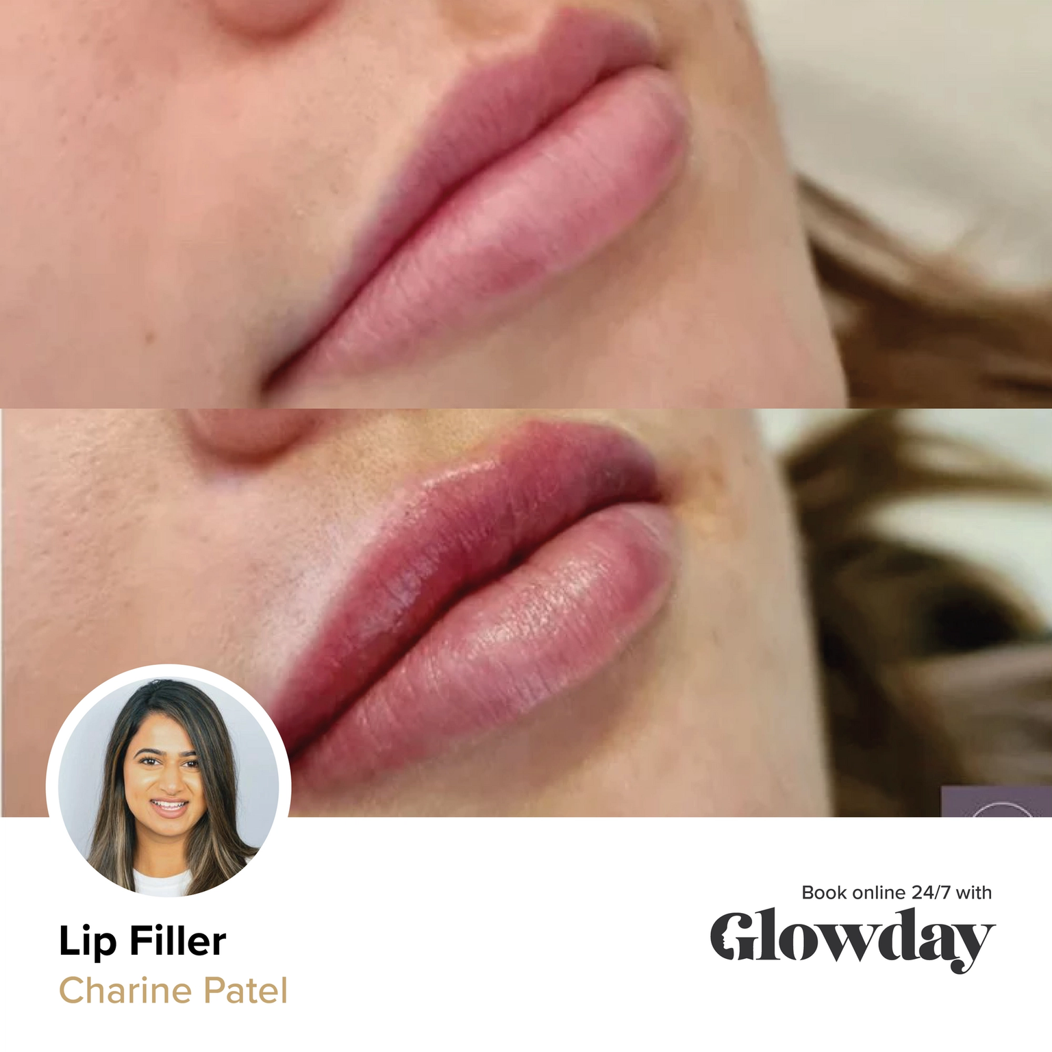 Lip filler before and after - Charine Patel