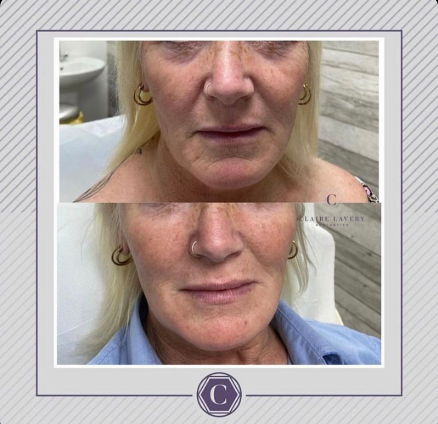 Midface fillers before and after