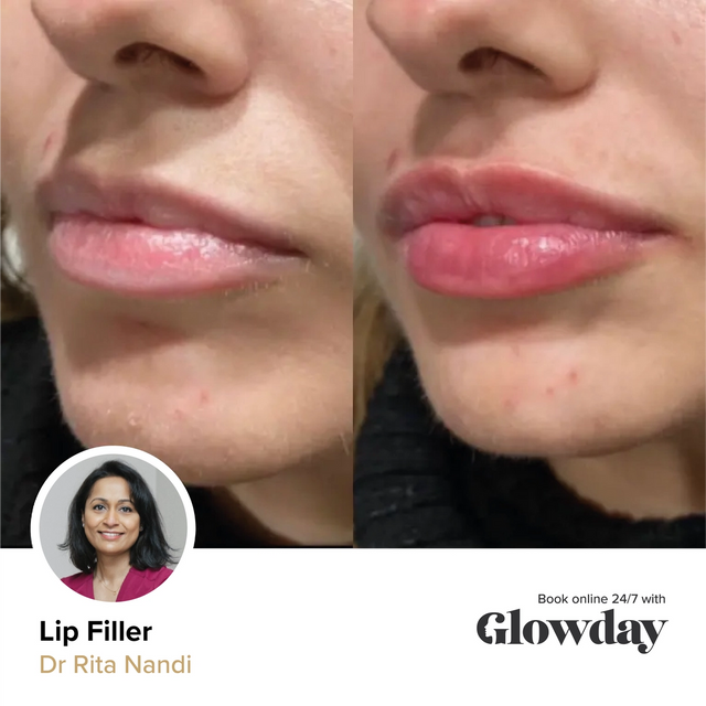 Dr Rita Nandi's lip filler results
