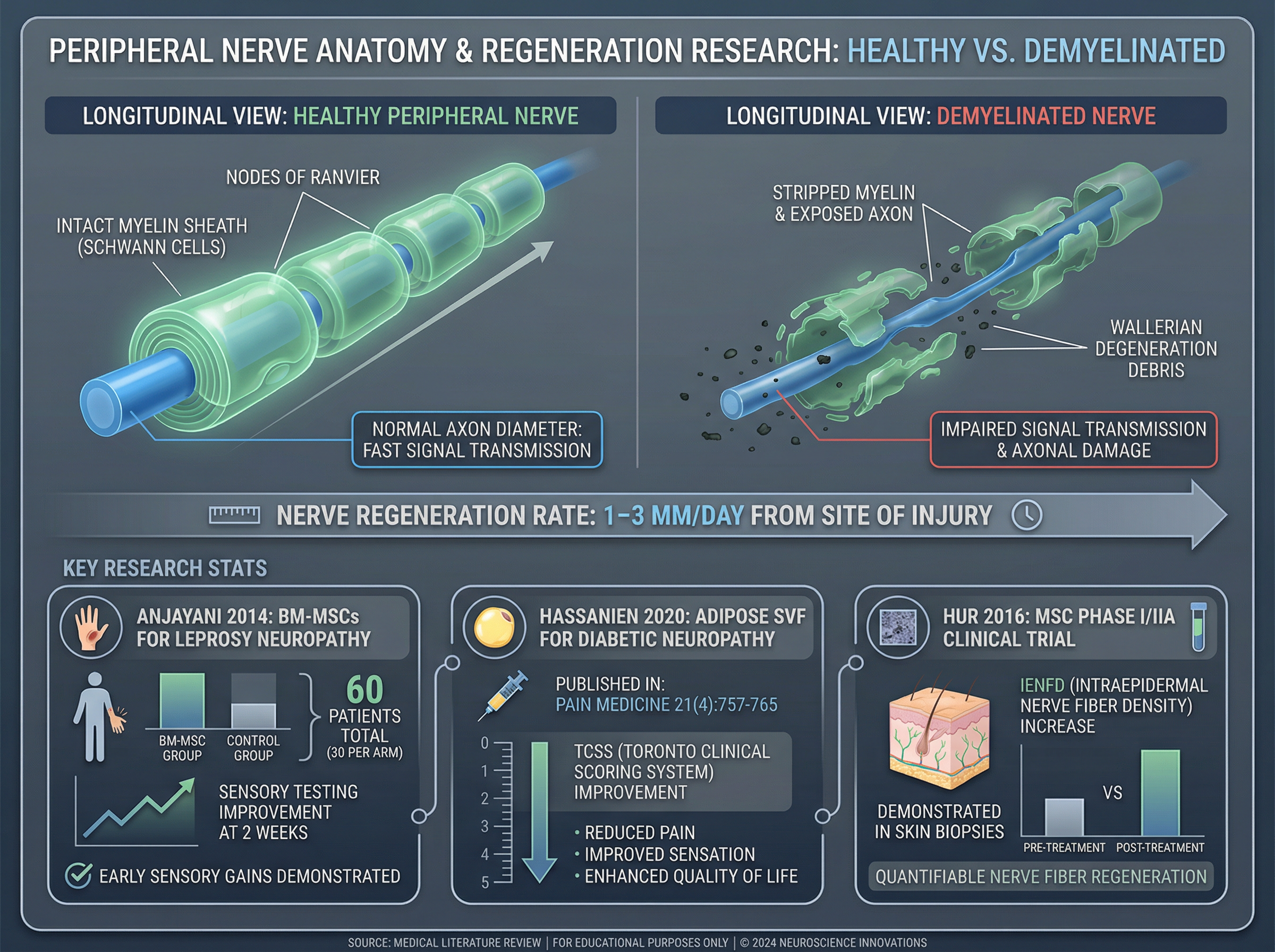 Illustration showing peripheral nerve anatomy with myelin sheath, axon, and comparison of healthy vs. demyelinated nerve