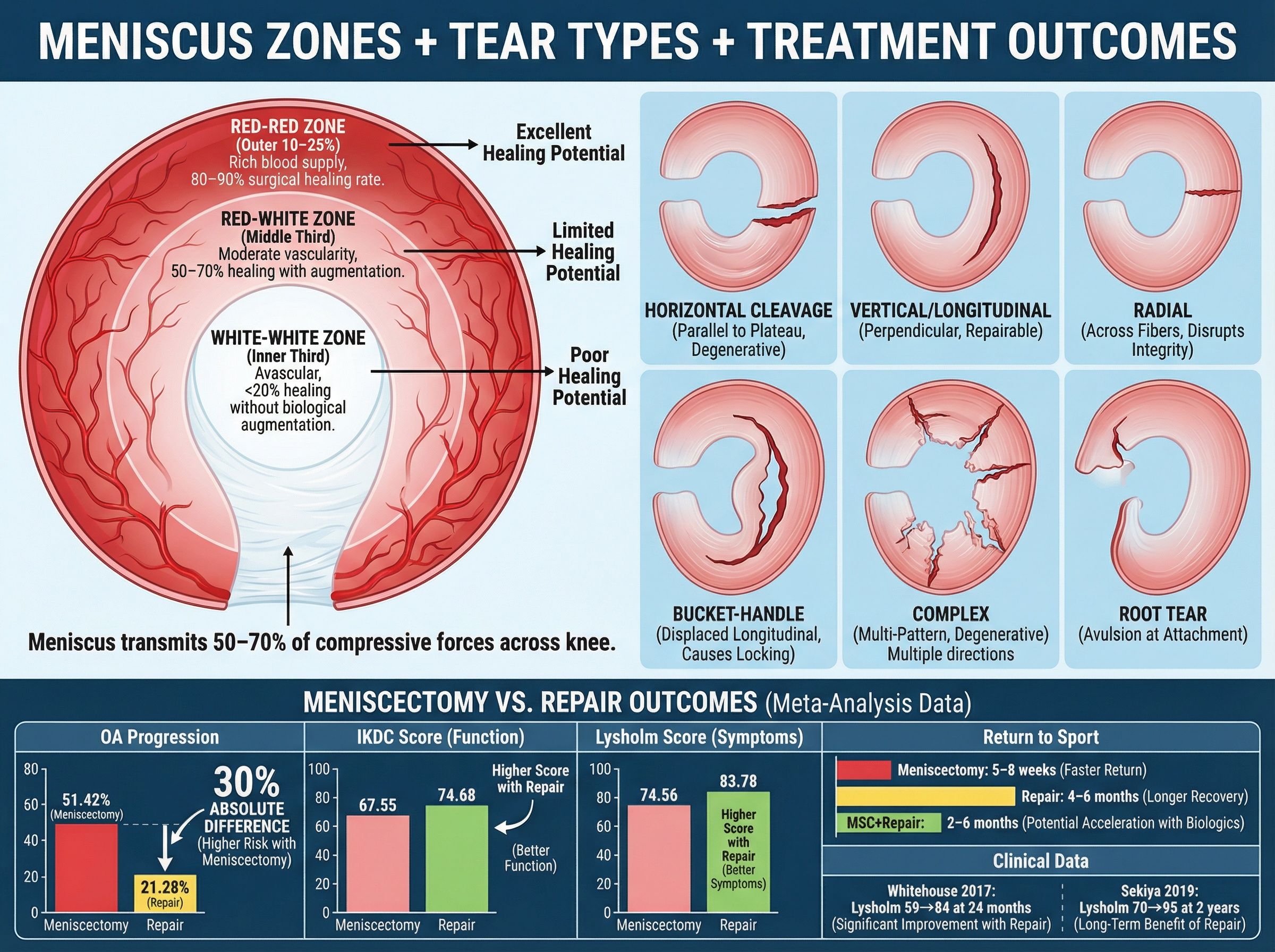 Diagram of meniscus tear types: radial, horizontal, bucket handle