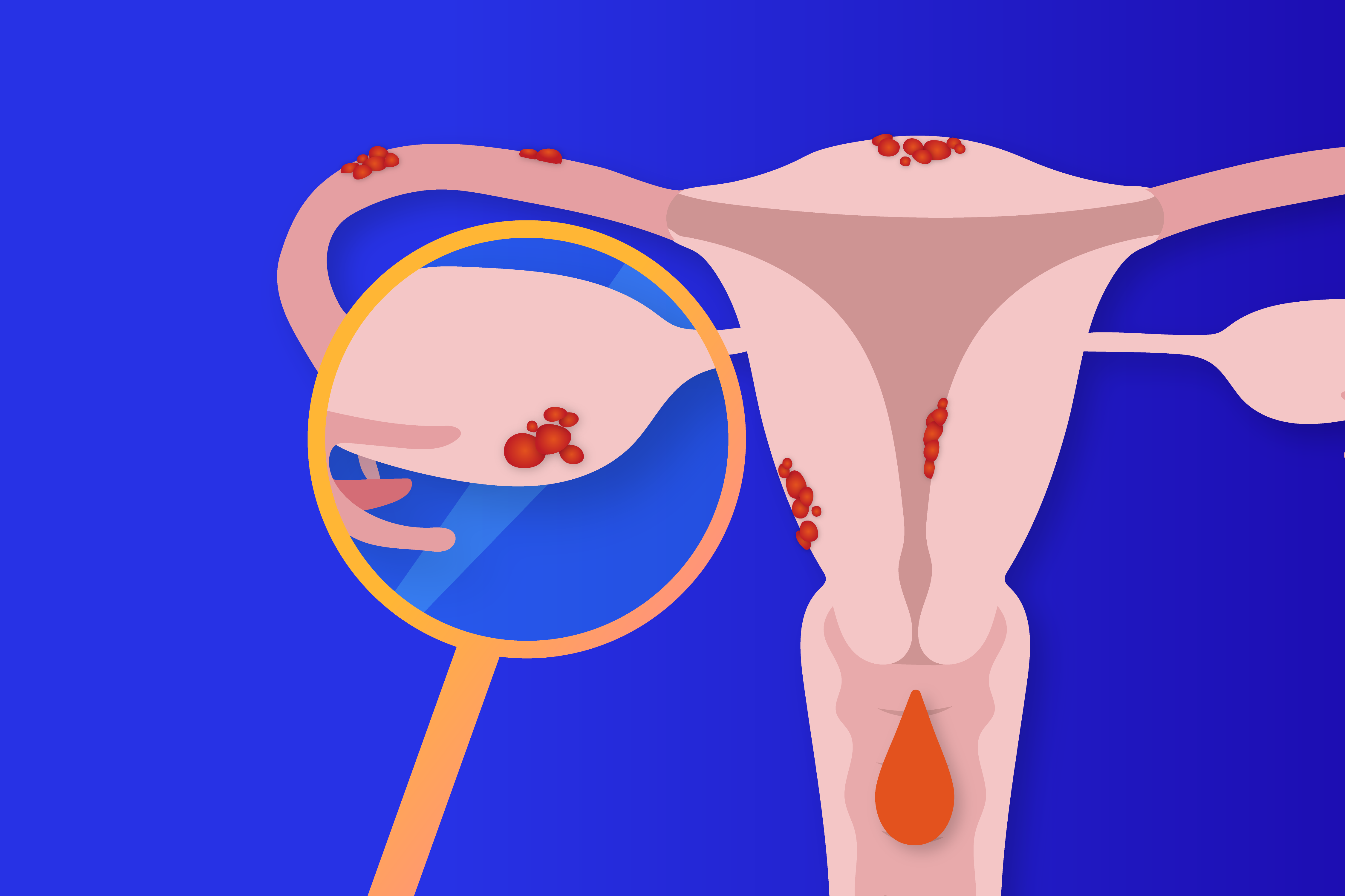 Illustrasjon av en livmor med endometriose, der en variant av slimhinnen i livmor er på steder den ikke skal være.