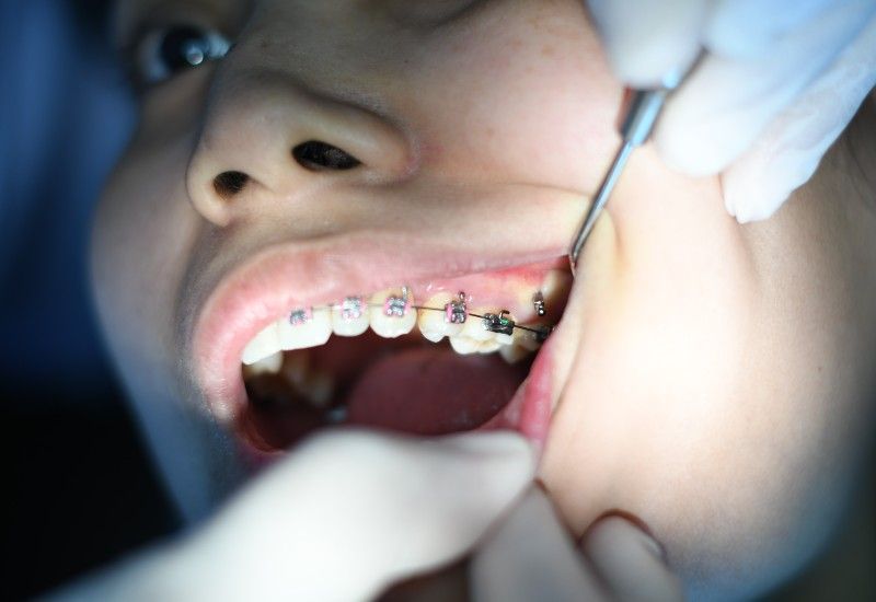 Ung person hos tannlegen for å undersøke tannreguleringen