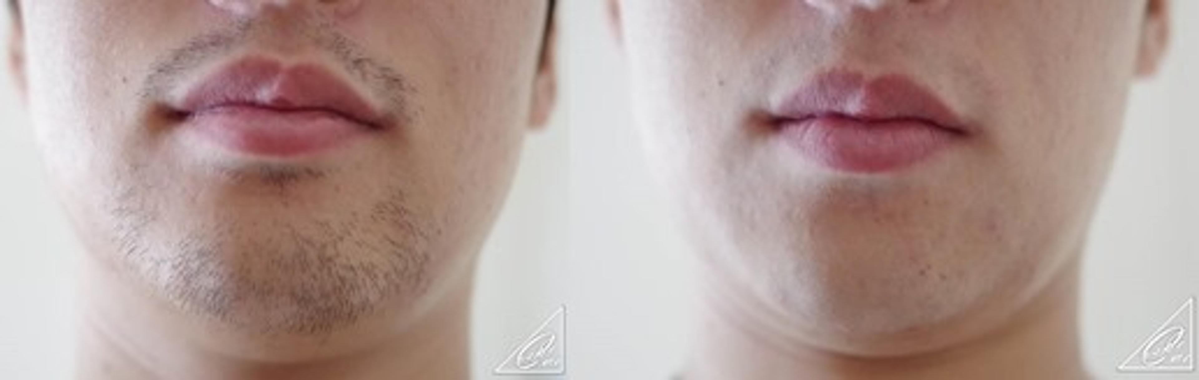 hige_beforafter_samuraiedge