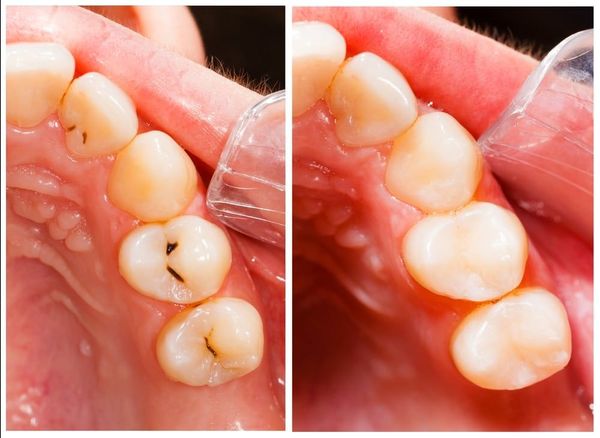 Soins des caries